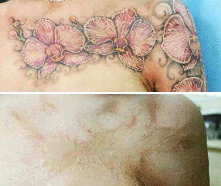 tatouages de cicatrices tâches